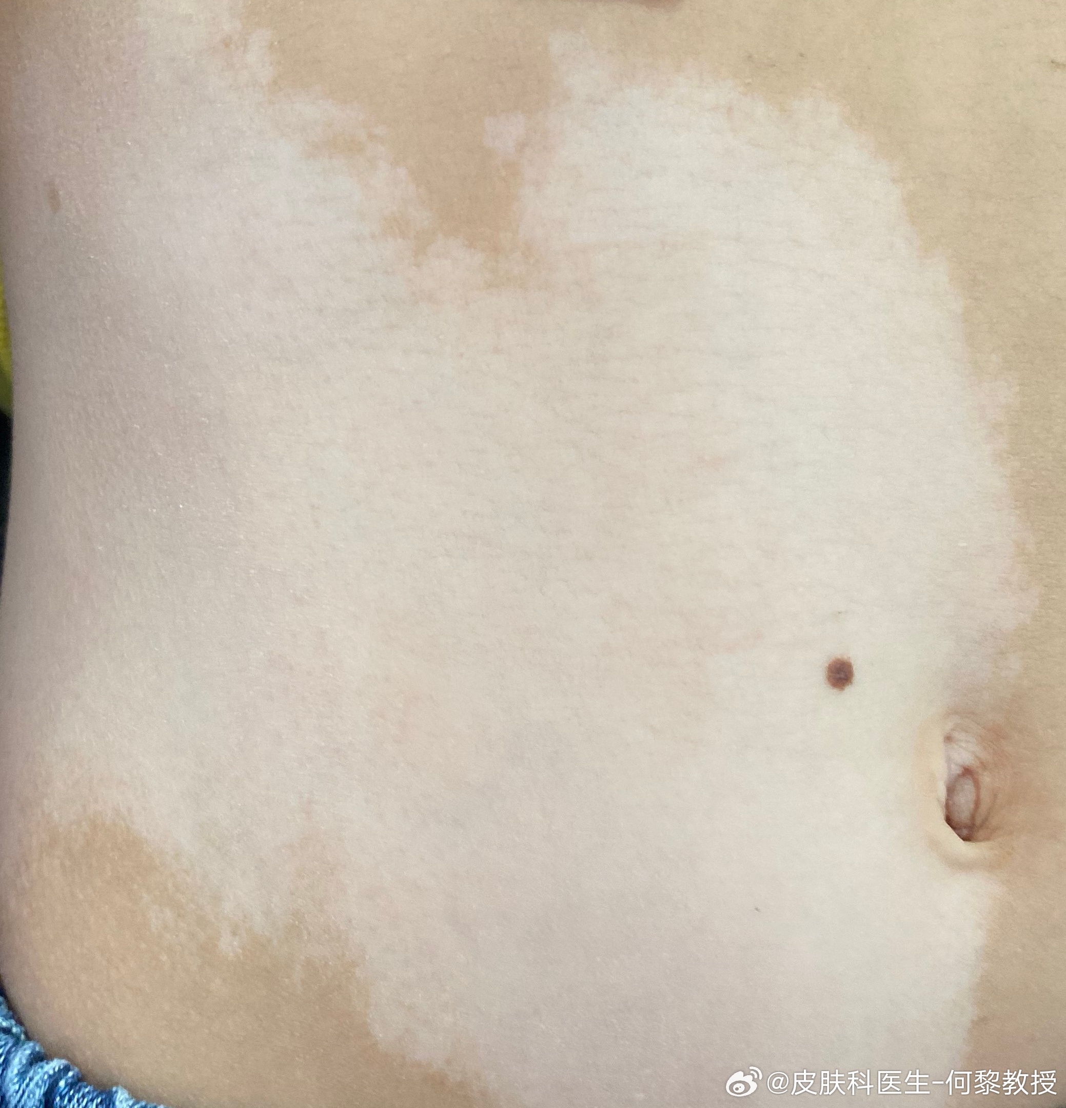 白斑治療新進(jìn)展揭秘，小巷深處的秘密小店探索之路