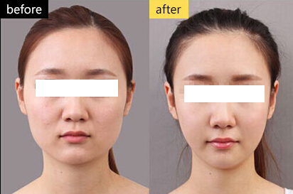 注射瘦臉針瘦臉價格詳解，全面了解瘦臉針費用及注意事項