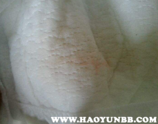 最新肺炎淤青的成因、表現(xiàn)與防治策略解析