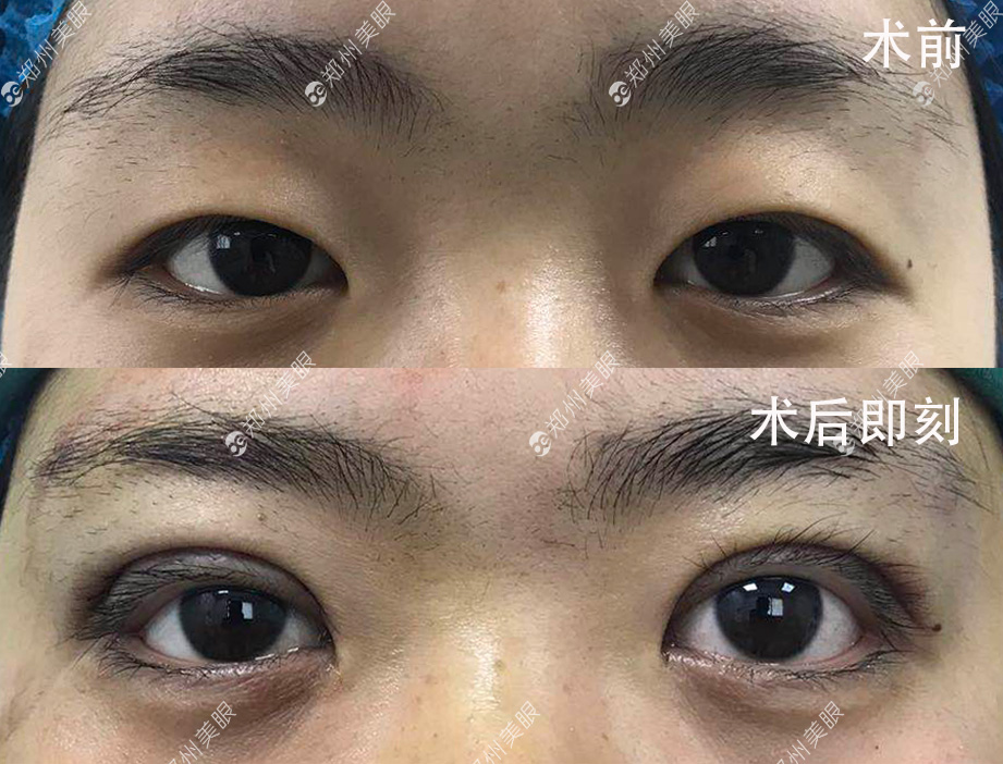 最新雙眼皮手術(shù)技巧，創(chuàng)新割雙眼皮方法解析